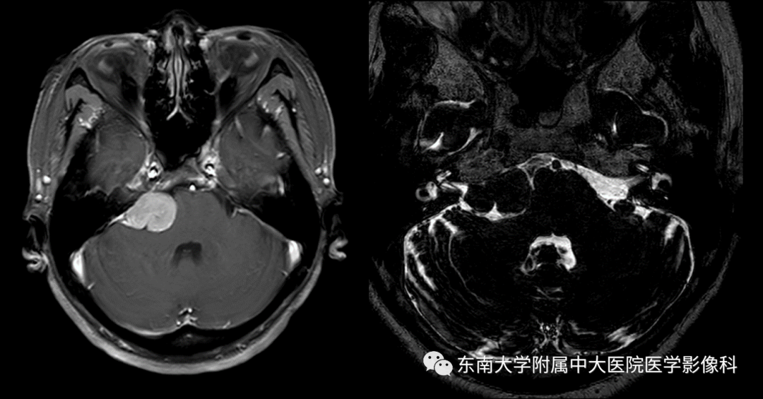 【PPT】颅神经原发肿瘤