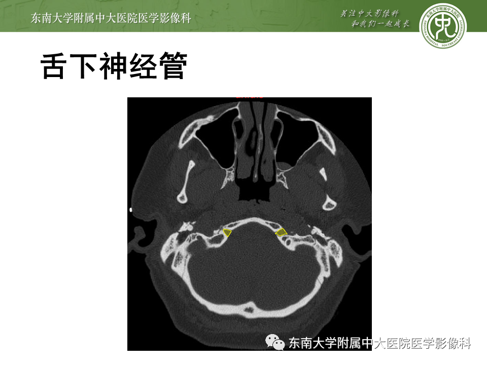 【PPT】颅神经原发肿瘤