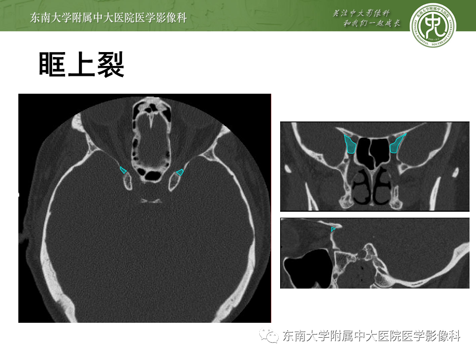 【PPT】颅神经原发肿瘤