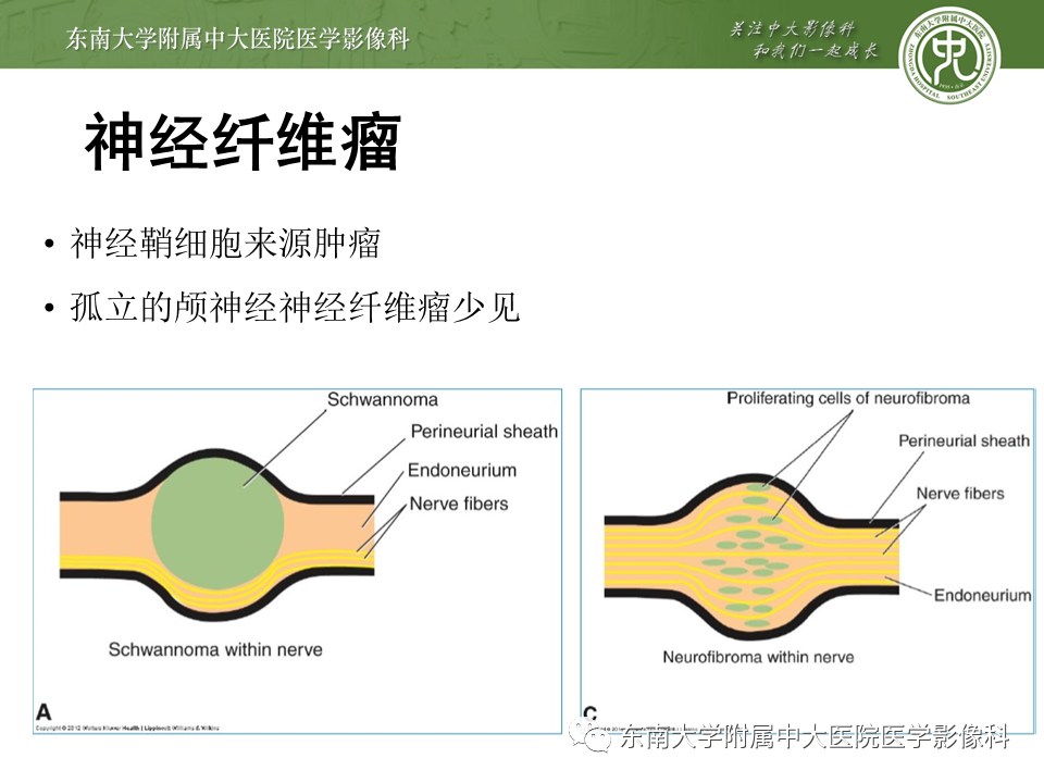 【PPT】颅神经原发肿瘤