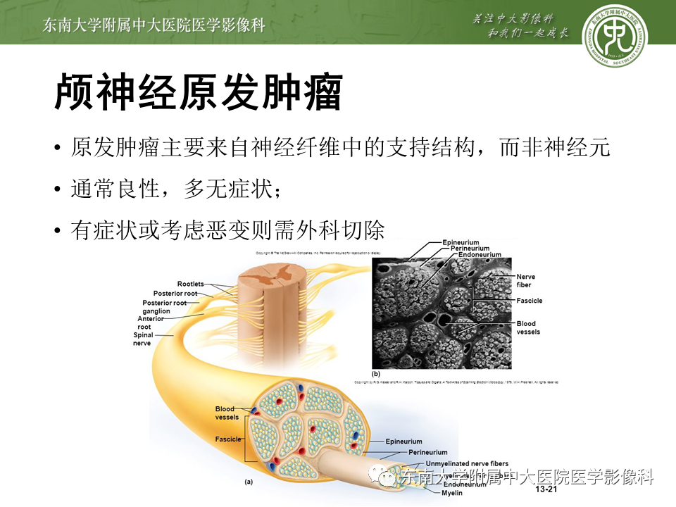 【PPT】颅神经原发肿瘤