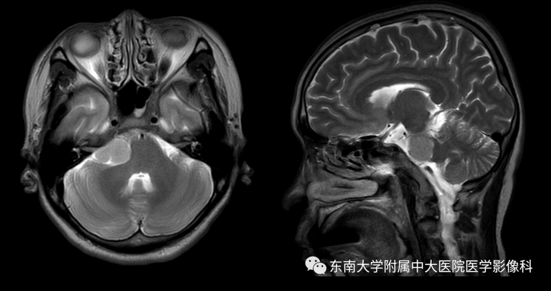 【PPT】颅神经原发肿瘤