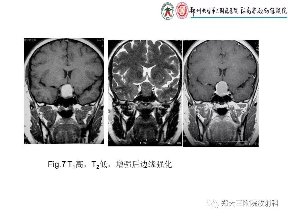 【PPT】Rathke 's 囊肿