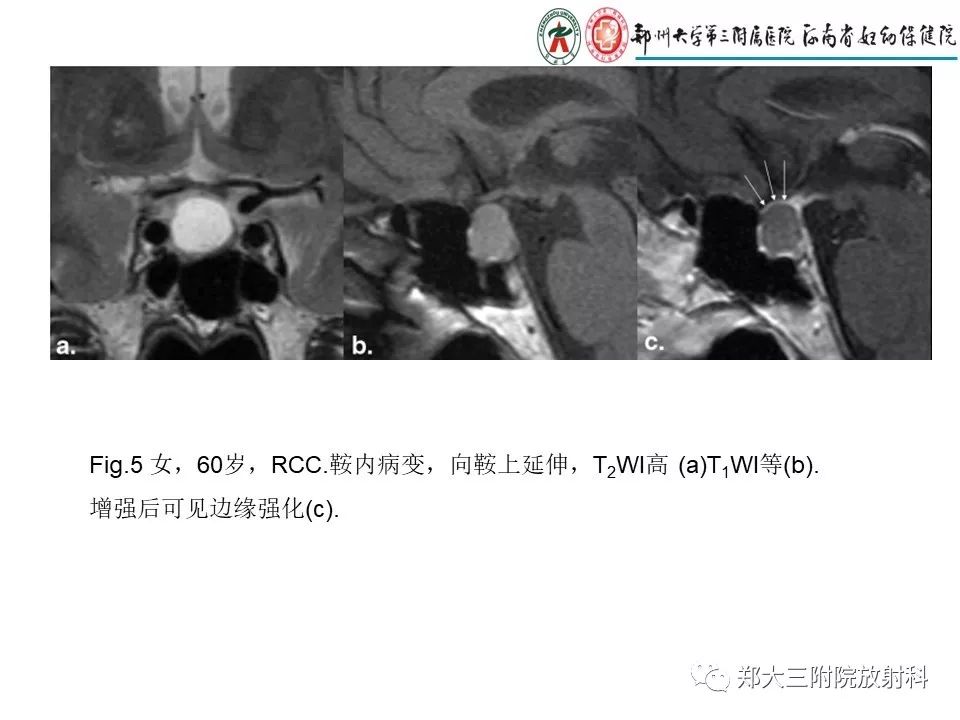 【PPT】Rathke 's 囊肿