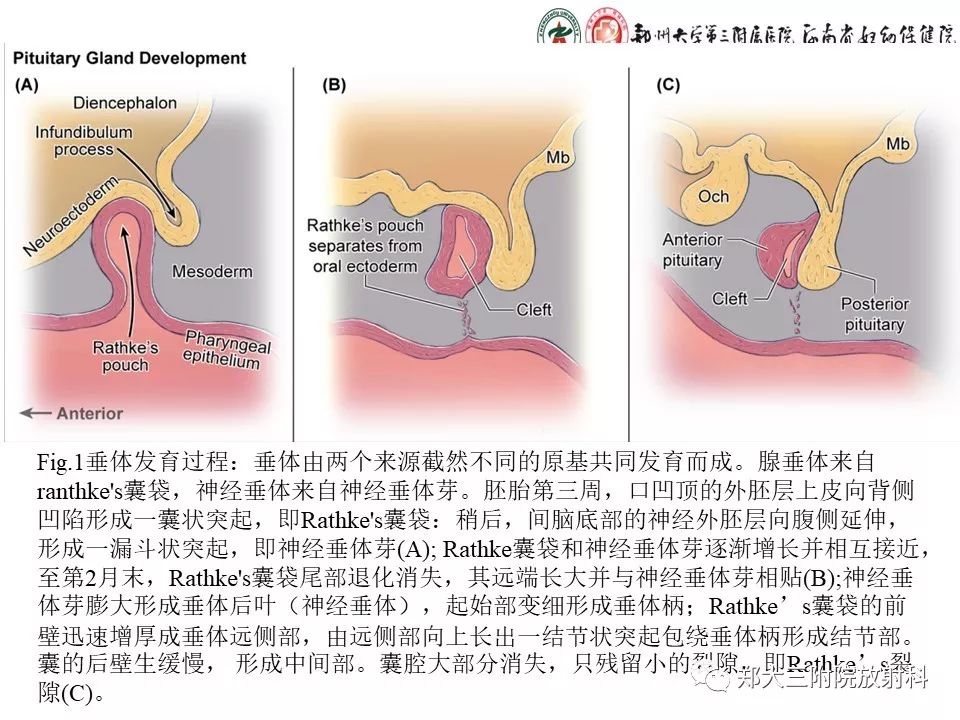 【PPT】Rathke 's 囊肿