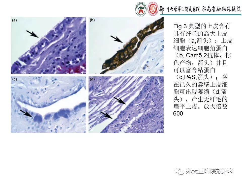 【PPT】Rathke 's 囊肿