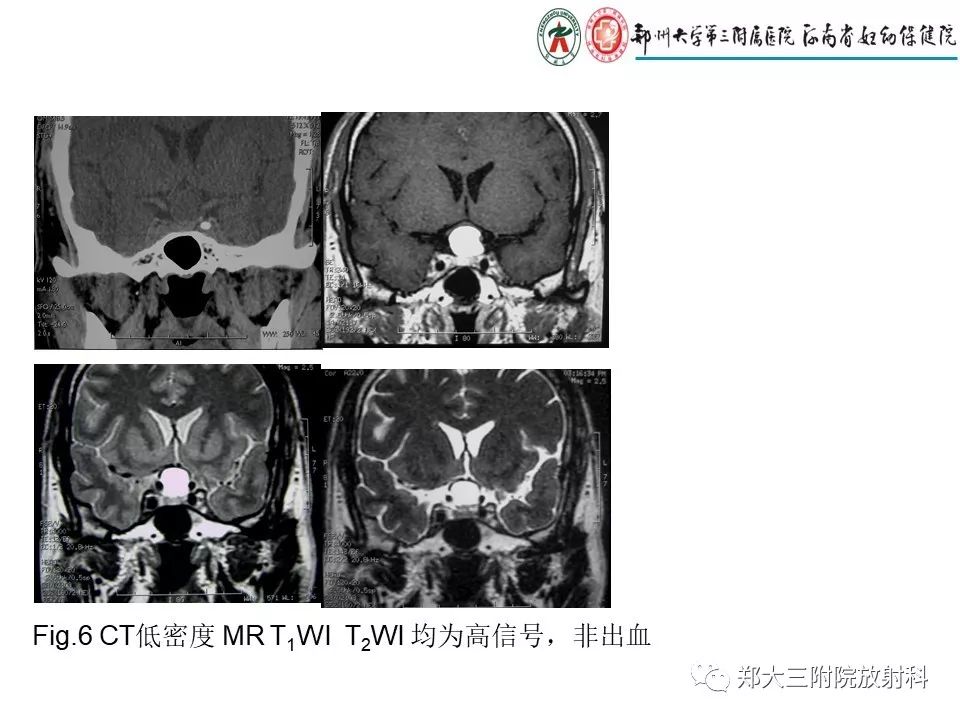 【PPT】Rathke 's 囊肿