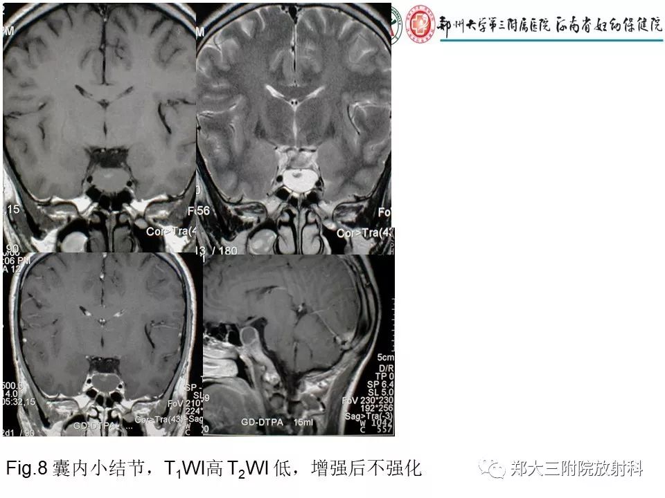 【PPT】Rathke 's 囊肿
