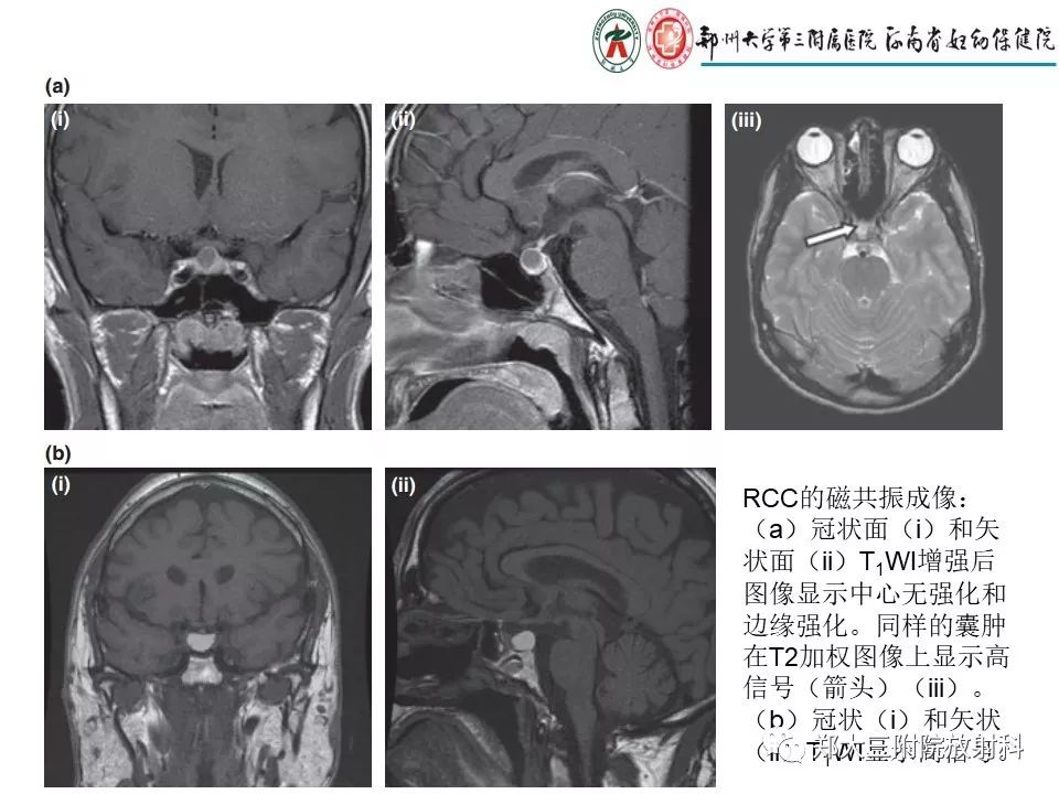 【PPT】Rathke 's 囊肿
