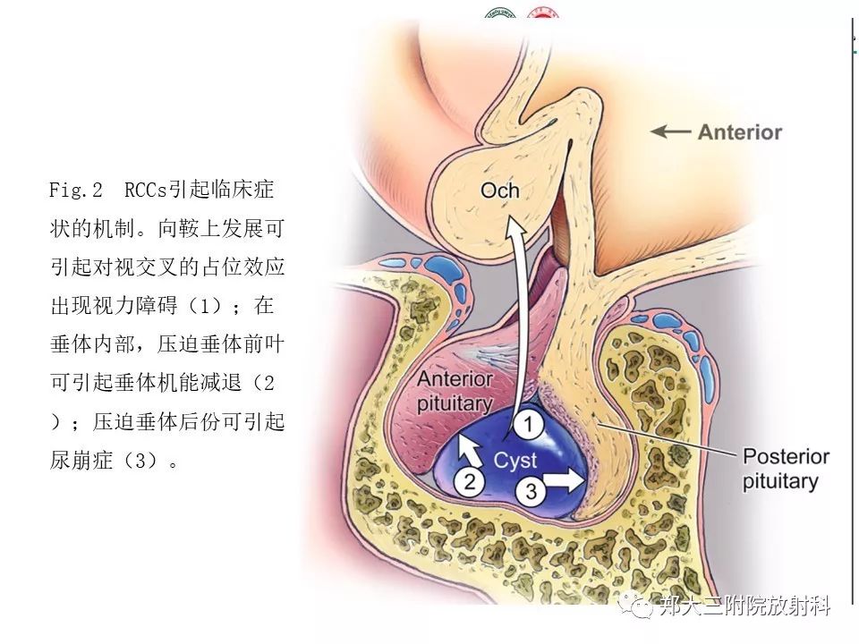【PPT】Rathke 's 囊肿