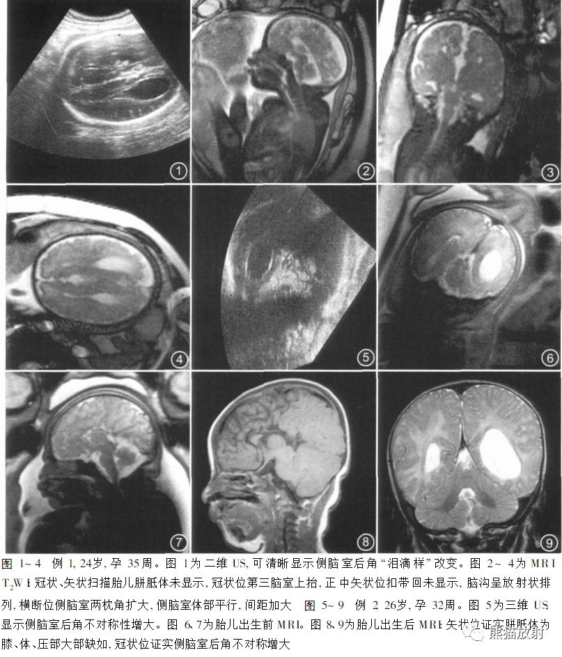 胎儿胼胝体发育不全