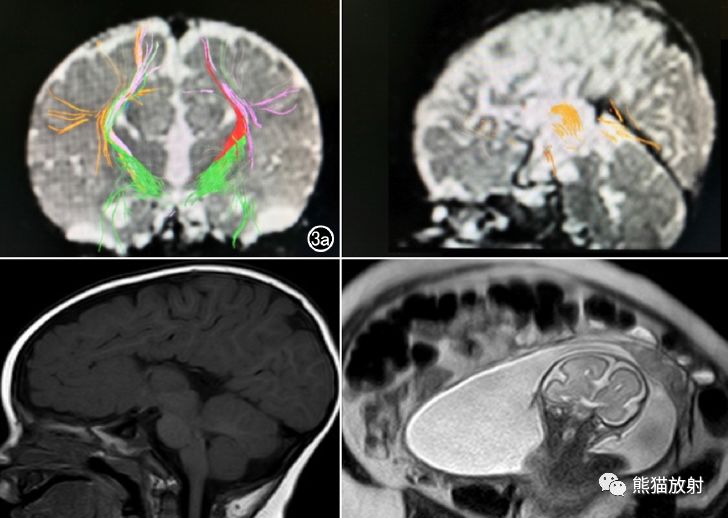 胎儿胼胝体发育不全