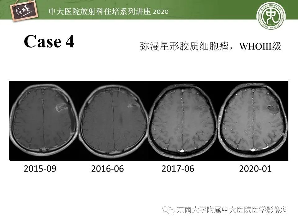 【PPT】胶质瘤复发与放射性脑损伤MR鉴别