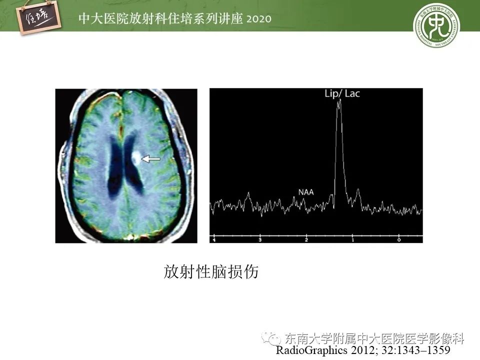 【PPT】胶质瘤复发与放射性脑损伤MR鉴别
