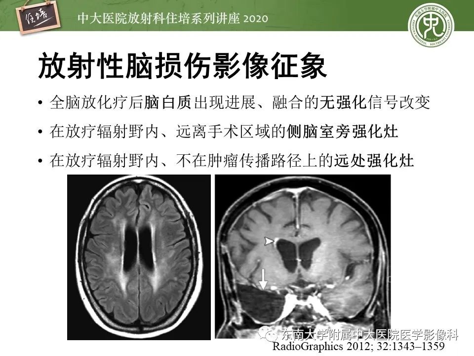 【PPT】胶质瘤复发与放射性脑损伤MR鉴别