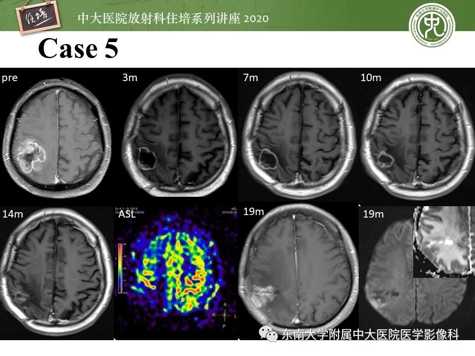 【PPT】胶质瘤复发与放射性脑损伤MR鉴别