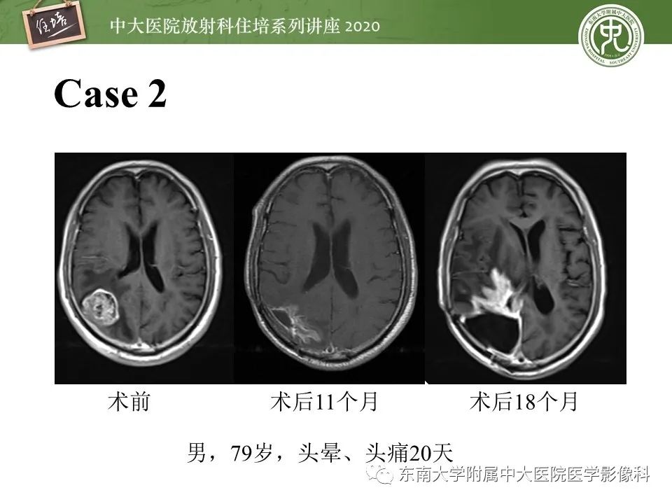 【PPT】胶质瘤复发与放射性脑损伤MR鉴别