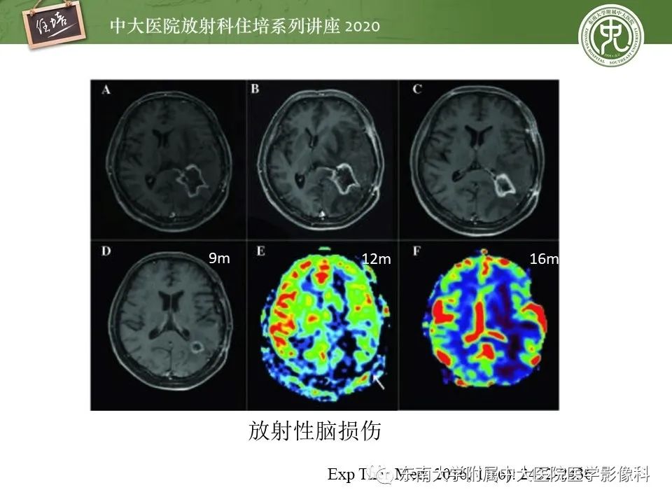 【PPT】胶质瘤复发与放射性脑损伤MR鉴别