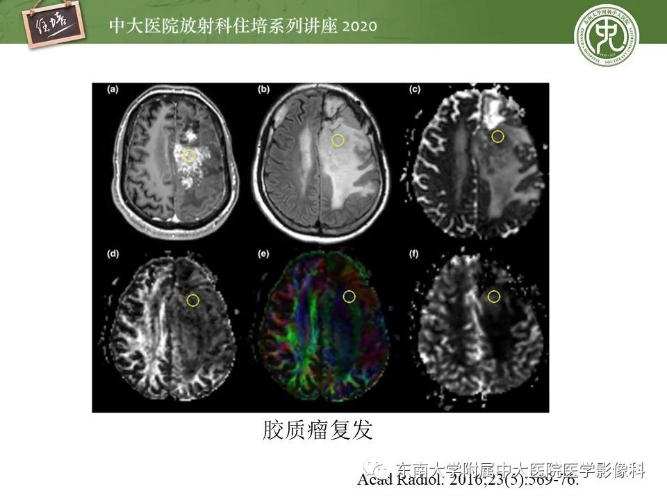 【PPT】胶质瘤复发与放射性脑损伤MR鉴别