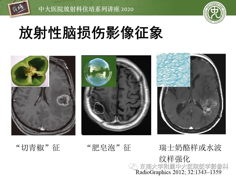 【PPT】胶质瘤复发与放射性脑损伤MR鉴别