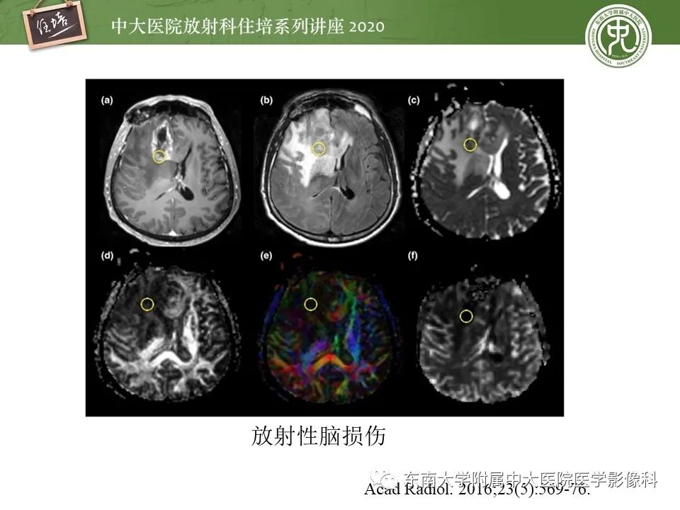 【PPT】胶质瘤复发与放射性脑损伤MR鉴别
