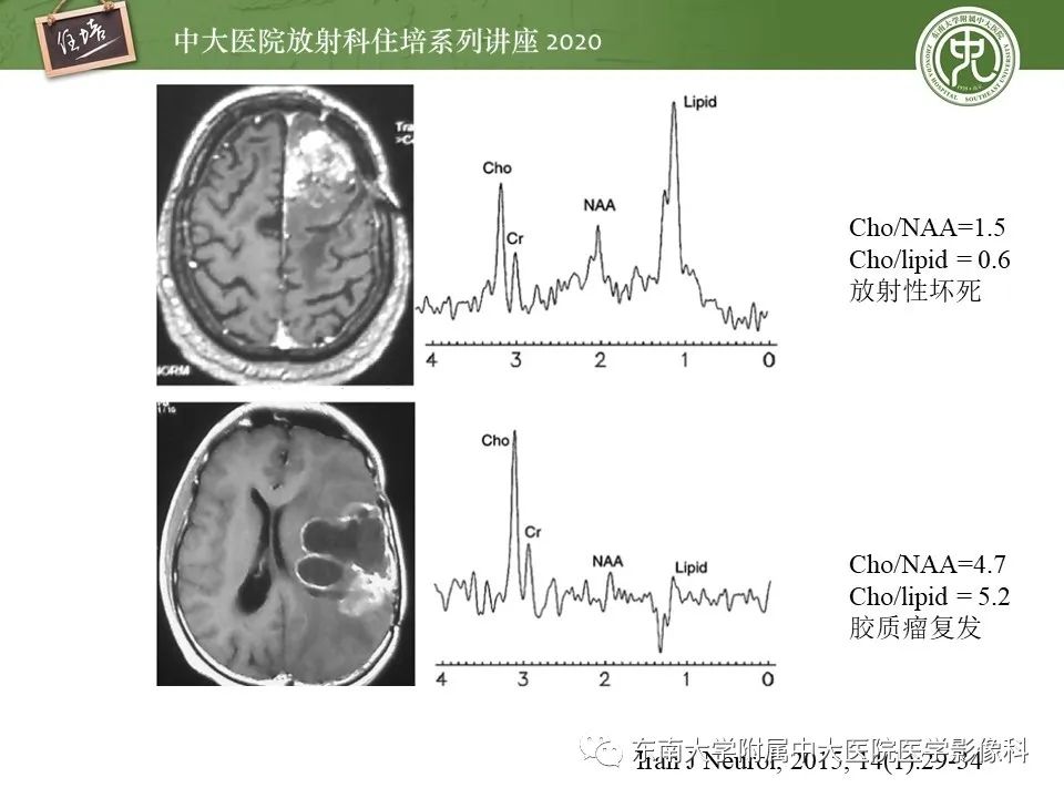【PPT】胶质瘤复发与放射性脑损伤MR鉴别