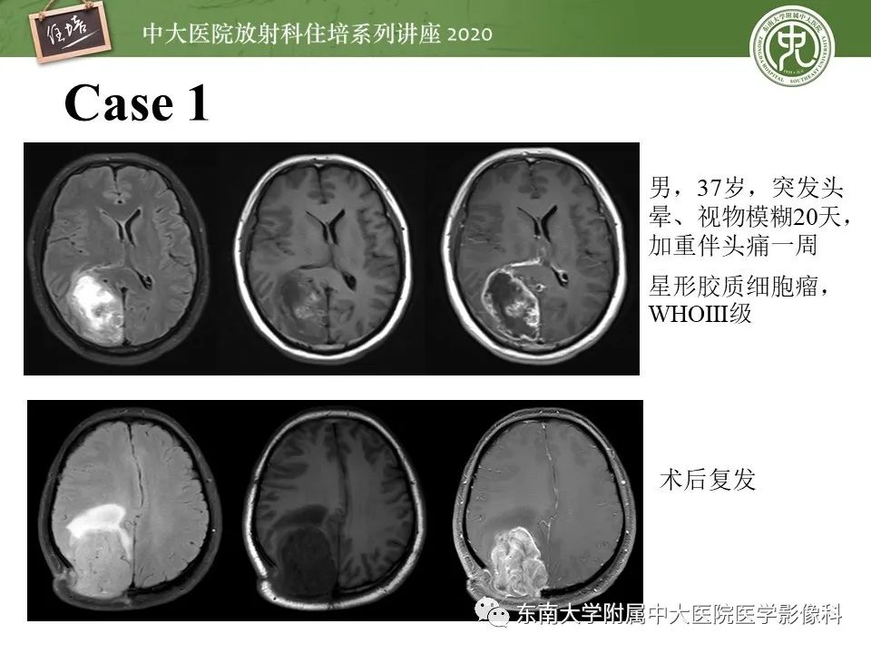 【PPT】胶质瘤复发与放射性脑损伤MR鉴别