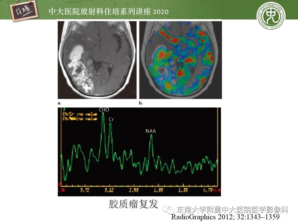 【PPT】胶质瘤复发与放射性脑损伤MR鉴别