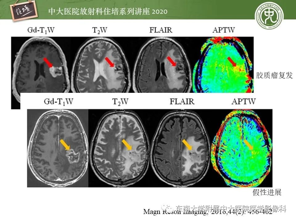 【PPT】胶质瘤复发与放射性脑损伤MR鉴别