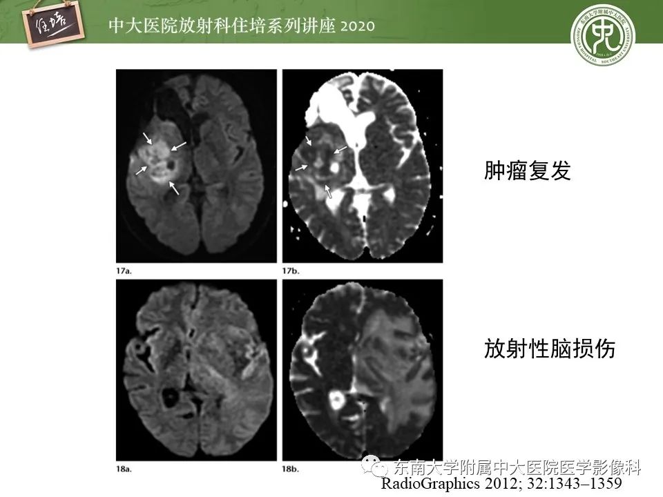 【PPT】胶质瘤复发与放射性脑损伤MR鉴别
