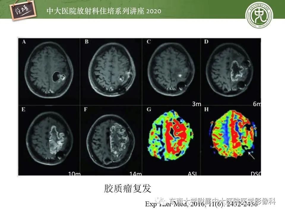 【PPT】胶质瘤复发与放射性脑损伤MR鉴别