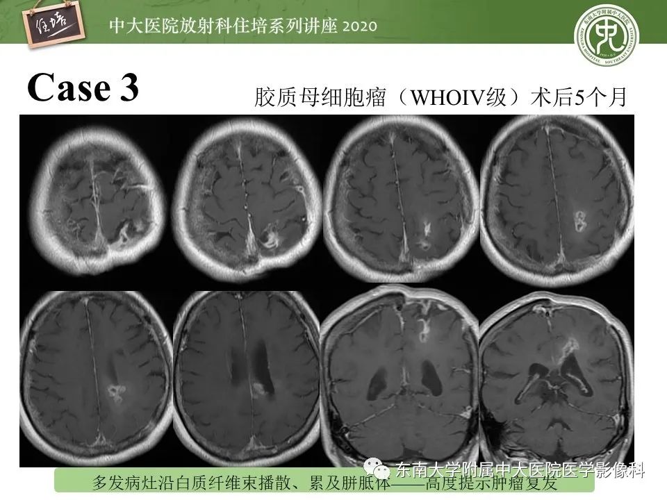 【PPT】胶质瘤复发与放射性脑损伤MR鉴别