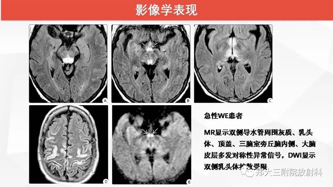 【PPT】Wernicke脑病的影像诊断
