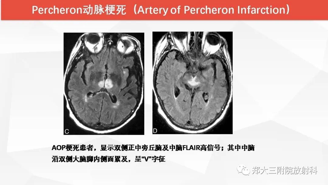 【PPT】Wernicke脑病的影像诊断