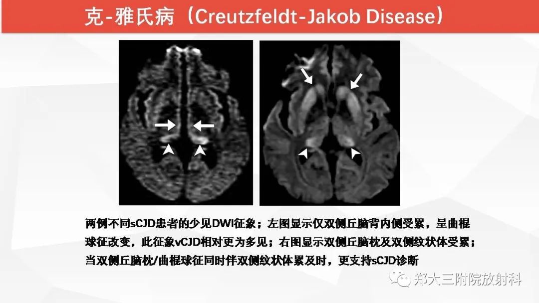 【PPT】Wernicke脑病的影像诊断