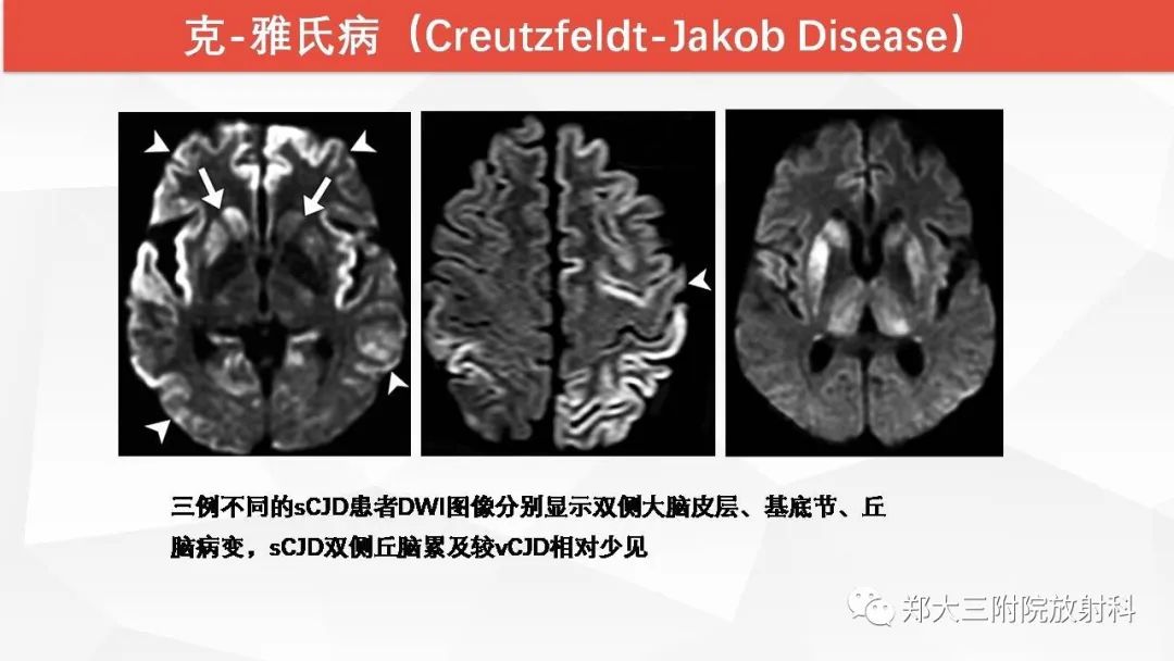 【PPT】Wernicke脑病的影像诊断