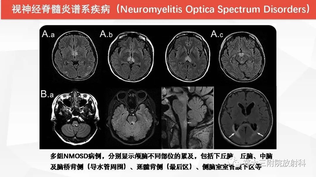 【PPT】Wernicke脑病的影像诊断