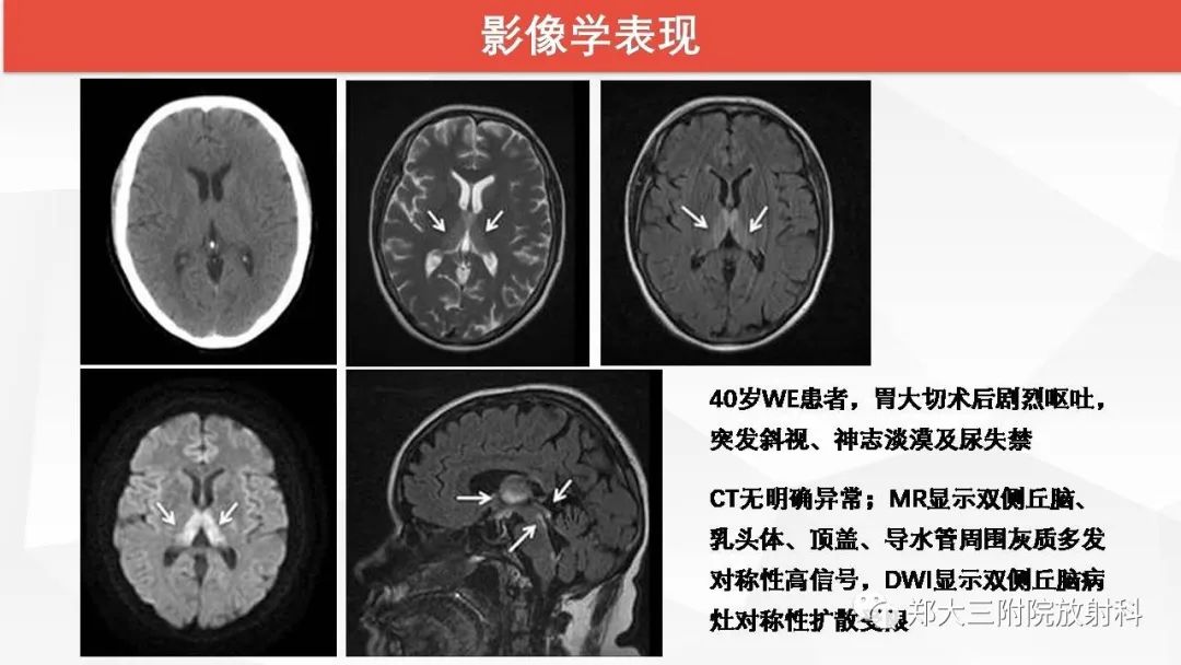 【PPT】Wernicke脑病的影像诊断