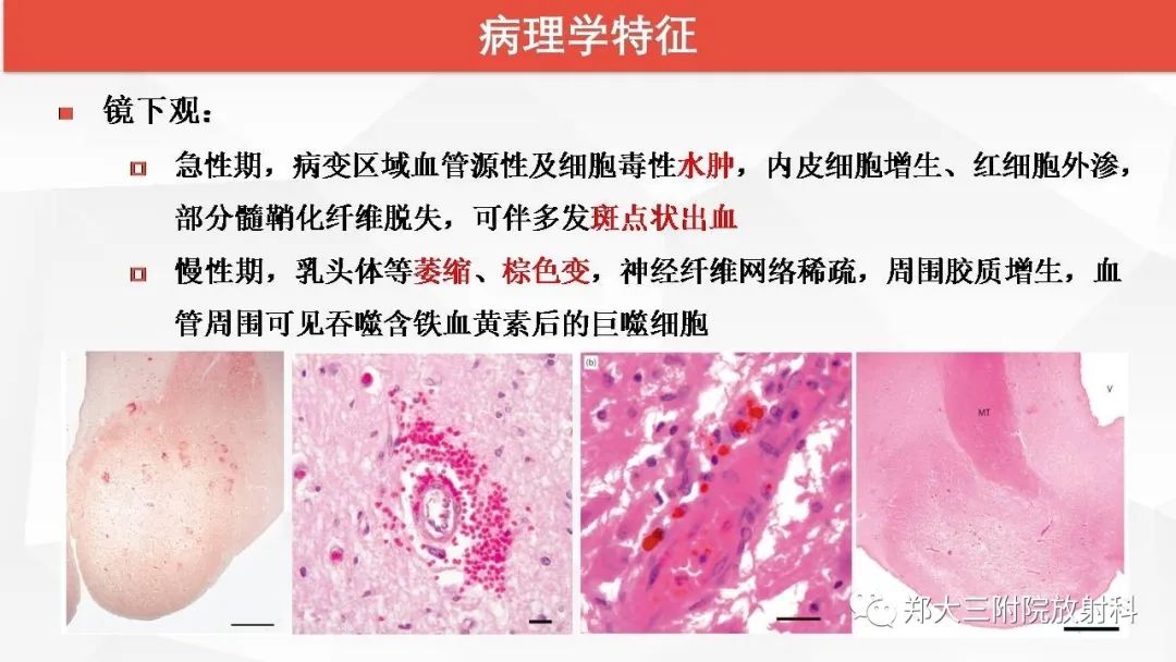 【PPT】Wernicke脑病的影像诊断