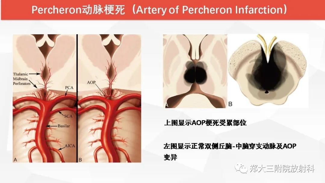 【PPT】Wernicke脑病的影像诊断