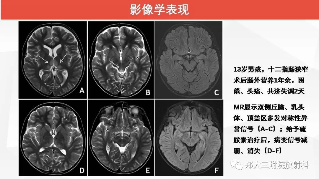 【PPT】Wernicke脑病的影像诊断