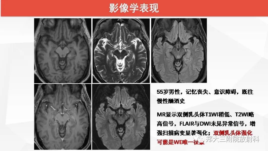 【PPT】Wernicke脑病的影像诊断