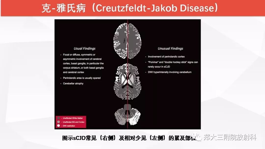 【PPT】Wernicke脑病的影像诊断