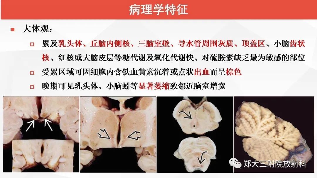 【PPT】Wernicke脑病的影像诊断