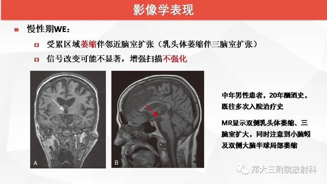 【PPT】Wernicke脑病的影像诊断