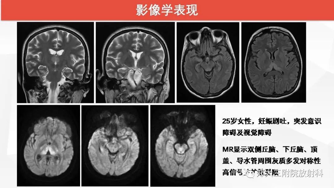 【PPT】Wernicke脑病的影像诊断