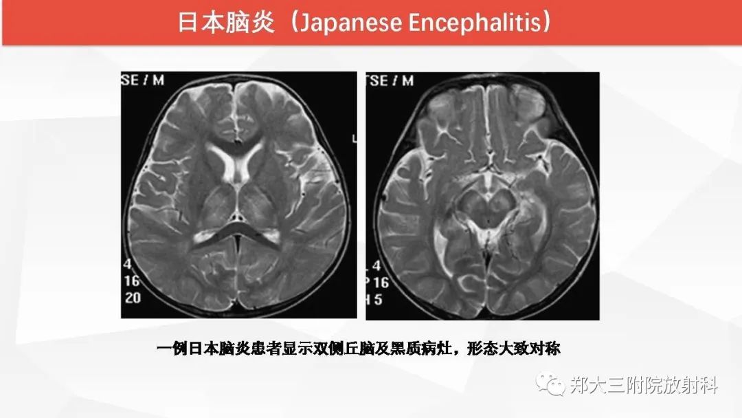 【PPT】Wernicke脑病的影像诊断