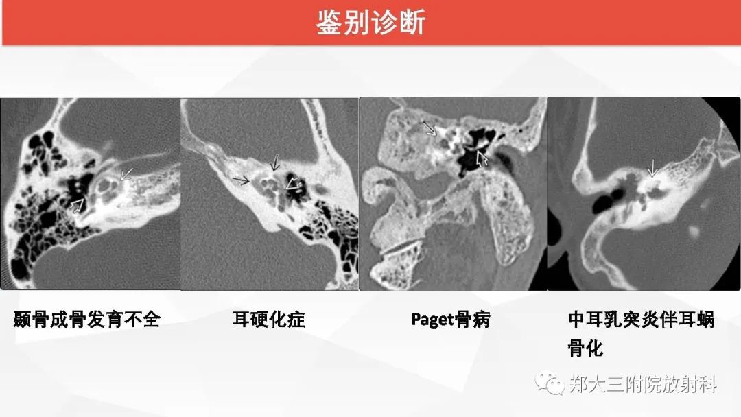 【PPT】耳硬化症的影像诊断