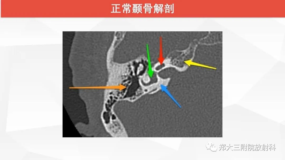 【PPT】耳硬化症的影像诊断