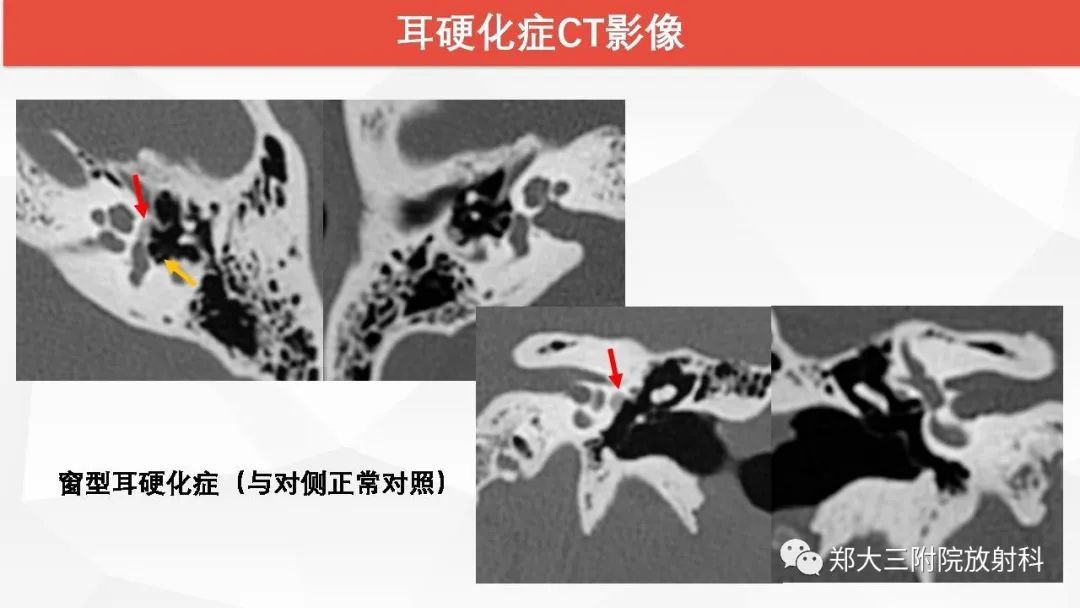 【PPT】耳硬化症的影像诊断